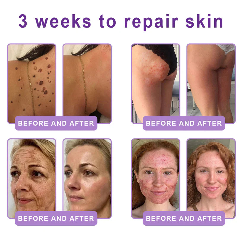 ✨LAST DAY BUY 1 GET 1 FREE✨ HISKIN PDRN Multi-Peptide Massaging Body RollerCream Visibly Firmer Anti-aging, Lifted Skin in 72 Hours — No Needles, No Clinic Visits