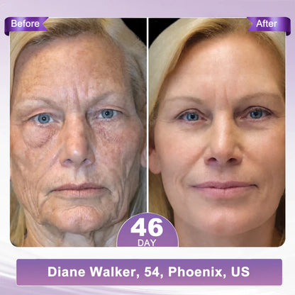 ✨LAST DAY BUY 1 GET 1 FREE✨ HISKIN PDRN Multi-Peptide Massaging Body RollerCream Visibly Firmer Anti-aging, Lifted Skin in 72 Hours — No Needles, No Clinic Visits