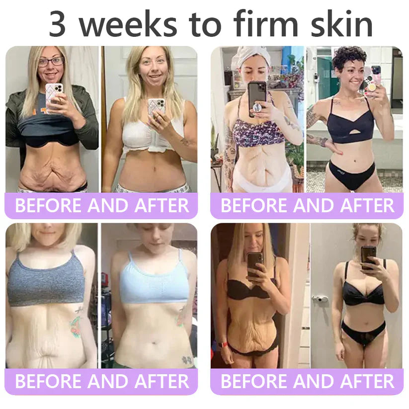 ✨LAST DAY BUY 1 GET 1 FREE✨ HISKIN PDRN Multi-Peptide Massaging Body RollerCream Visibly Firmer Anti-aging, Lifted Skin in 72 Hours — No Needles, No Clinic Visits